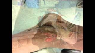 Diana's Foot Operation