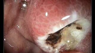 гастроскопия gastroscopia