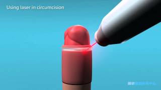 Laser Circumcision - Genesis Minimally Invasive Surgery Center