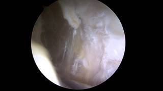 Scar Tissue Excision 30th June 2014 Part 1
