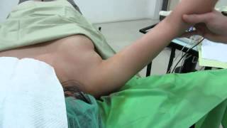 СЛУЧАЙ №47 ВИДЕО 2   ЛИПОСАКЦИЯ ПОДМЫШЕК     ARMPITS LIPOSUCTION