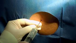 ANESTESIA EPIDURAL HD / RAQUIA