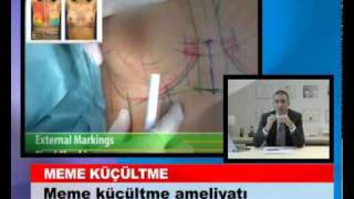 Göğüs Küçültme Ameliyatında Hasta Neler Yaşar