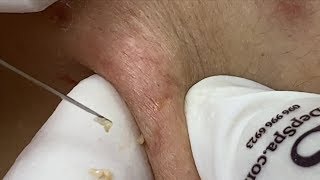 Acne Hidden Under Skin Due to Regular Makeup | Mụn Nhận To Do Thường Xuyên Trang Điểm - SacDepSpa#69