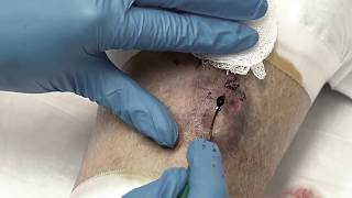Dr. Gilmore's Biggest Cyst Pops!  Pimple Popping, Zits & Acne