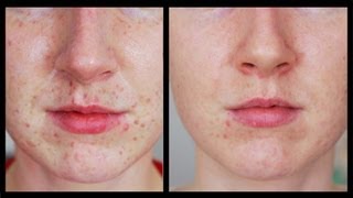 Freckles Be Gone! - My Laser Experience