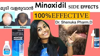 Minoxidil howto use|Side effects|Hairloss treatment|Mintop|Malayalam