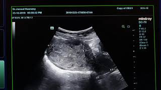 Adenomyosis Sonography