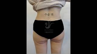 지방흡입 후 처진엉덩이 힙업성형