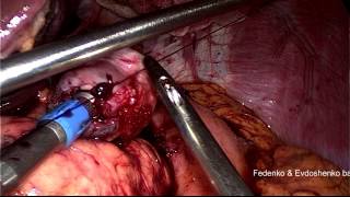 restoration of normal anatomy after gastric bypass, complete record, full HD