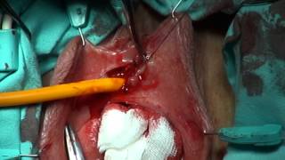 Komyakov technique of the transposition of female urethra