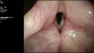 linfoma de laringe