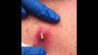 Satisfying cyst pop- it just keeps coming!!