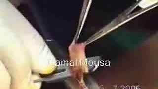 Circumcision Bone Cutting Method