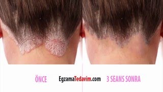 Atopik Egzama Nedir ?