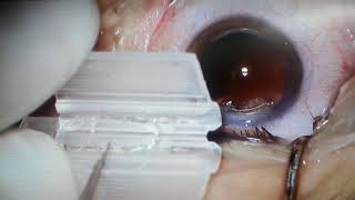 See lens Iol