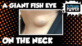 A Giant Fish Eye Cyst on The Neck