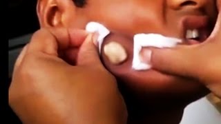 Blackheads and Pimple Popping vs Bikinis and Beach Babes