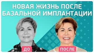 ? Об имплантации за 3 дня: как меняется жизнь после лечения. Отзыв реального пациента Smile-at-Once