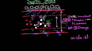 Septic Shock: Pathophysiology and Symptoms