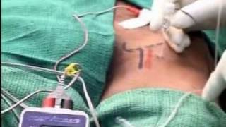 FEMORAL NERVE BLOCK