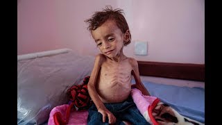 Global Journalist: Starving Yemen