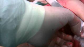 Toracotomía x mediastinitis