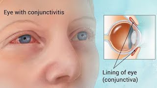 Conjunctivitis || Ophthalmology Videos  || Practice Online Education