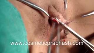 Labiaplasty Delhi Clitoris Unhooding India