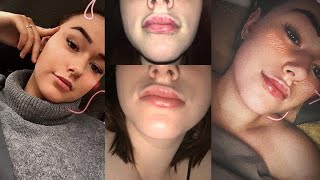 Lippen aufspritzen| Schmerzen, Kosten und die Tage danach ??