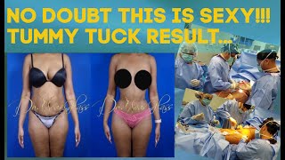 Her Sexy Body After The Tummy Tuck Procedure | Dr. Cortes Plastic Surgeon