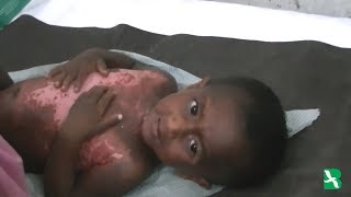 Bangladesh: Rohingya Child Burned in Rakhine Attack