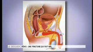 Fracture du pénis, la déchirure du corps caverneux   Couple   Bonjour docteur