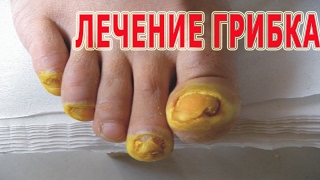 ★Лечение ГРИБКА НОГТЕЙ народными методами. 9 лучших рецептов против МИКОЗА.