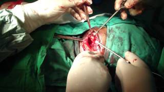 Submandibular Salivary Gland Excision