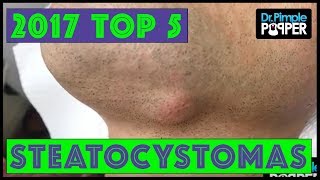 Dr Pimple Popper's Top 5 Steatocystoma POPS for 2017