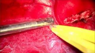 Parieto-temporo-occipital disconnection (Sturge-Weber disease)