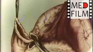 Резекция желудка © gastrectomy