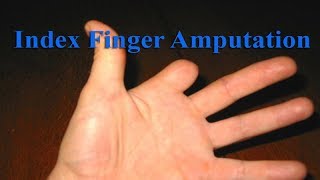 হাতের তর্জনী অপারেশন ।। Index Finger Amputation