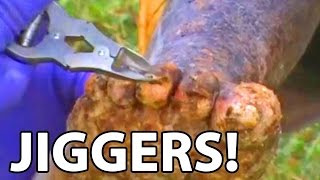 James' Crusty Crippling Jiggers Treated - Toenails Removed
