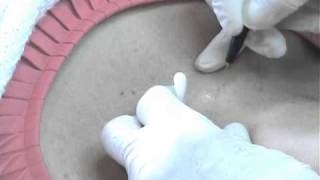 Skin tags neck