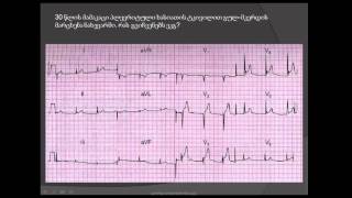 ეკგ. ნაადრევი რეპოლარიზაციის სინდრომი (ST სეგმენტის მაღალი გამოსვლის სინდრომი)