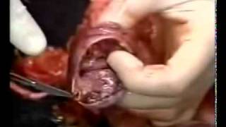 Autopsy part 2 of 2