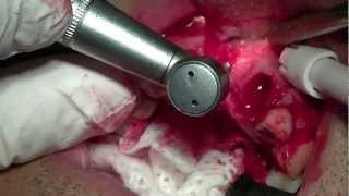 Bone Block Graft: Part 1