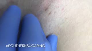Bikini Line Ingrown Hair Extraction at Southern Sugaring