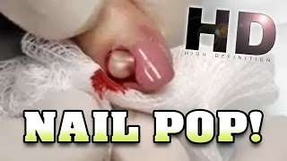 Bad Nail Infection with Dr. Gilmore!  Not Simply Nailogical!  ????