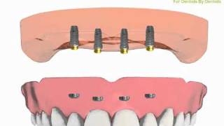 Overdenture