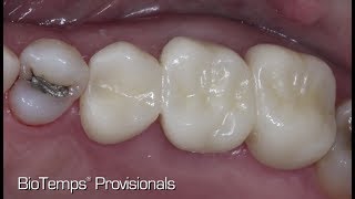 Case of the Week: Restoring the Posterior with a BioTemps® CAD Bridge