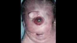 Sindrome de patau - Patau's syndrome trisomy 13