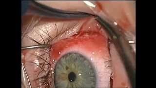 Eye surgery. Recession internal rectus. Хирург Хабибуллина Н.М., часть 1.